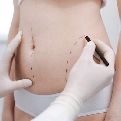 Lipo Abdominoplasty in Muscat - Tummy Tuck with Liposuction