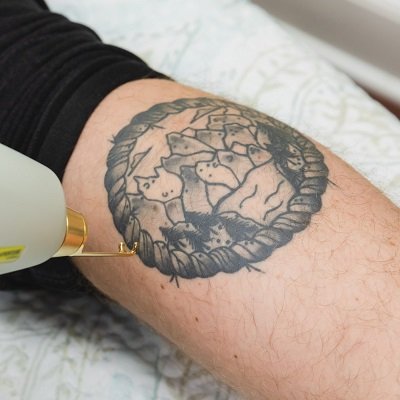 Tattoo Removal Muscat - Laser Removal Treatment Oman